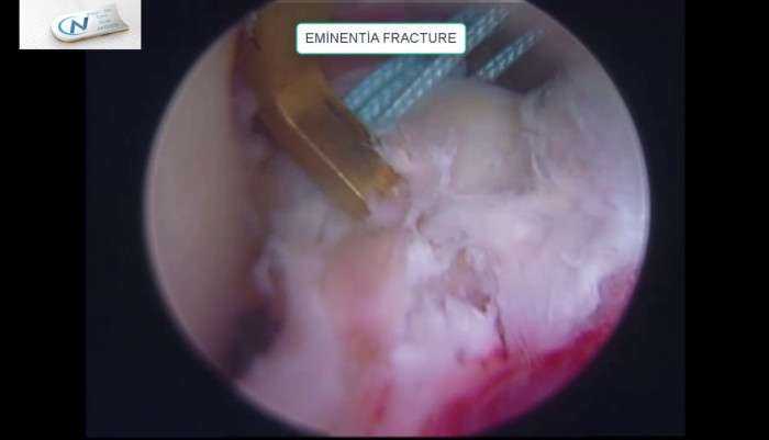 eminentia intercondylaris fracture,fracture,arthroscopic fixation,adult tibial spine fracture,suture fixation