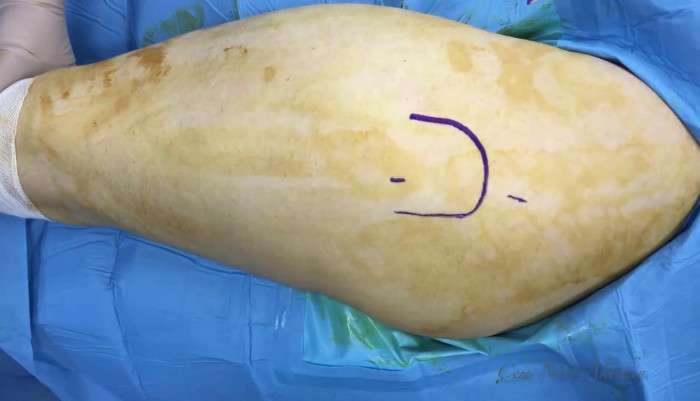 snapping hip,endoscopic,artthroscopic,relase,excision of bursitis